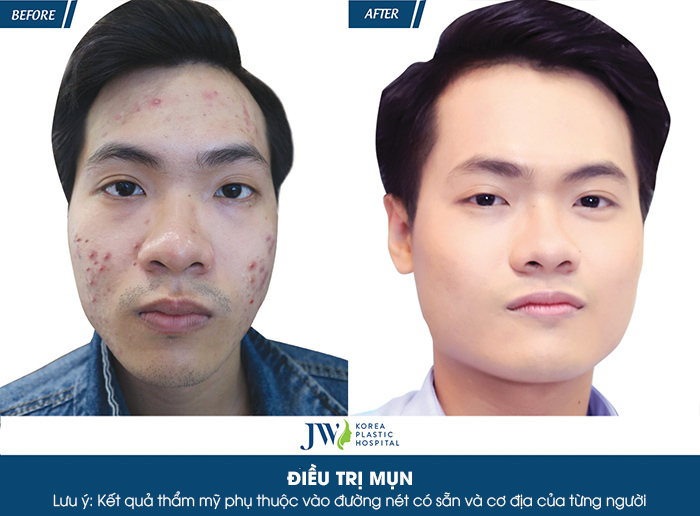 Kết quả trị mụn nam tại Spa JW Skincare Clinic