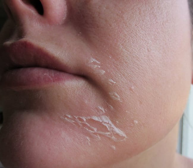Quy trình chăm sóc da sau peel hiệu quả và 4 điều cần lưu ý
