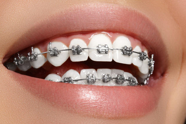 Niềng răng mắc cài kim loại phù hợp với đối tượng nào? | Vinmec